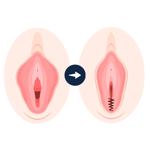 perineoplastia