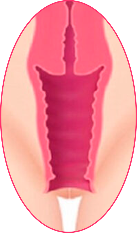 labioplastia