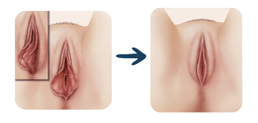 labioplastia_1